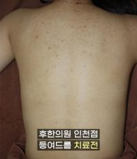 치료 전