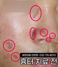 치료 전