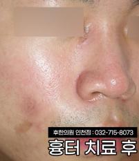 치료 후