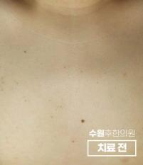 치료 전