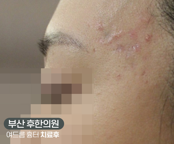 치료 후