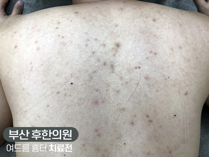 치료 전