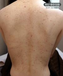 치료 전