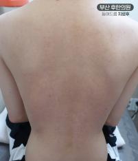 치료 후