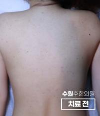치료 전
