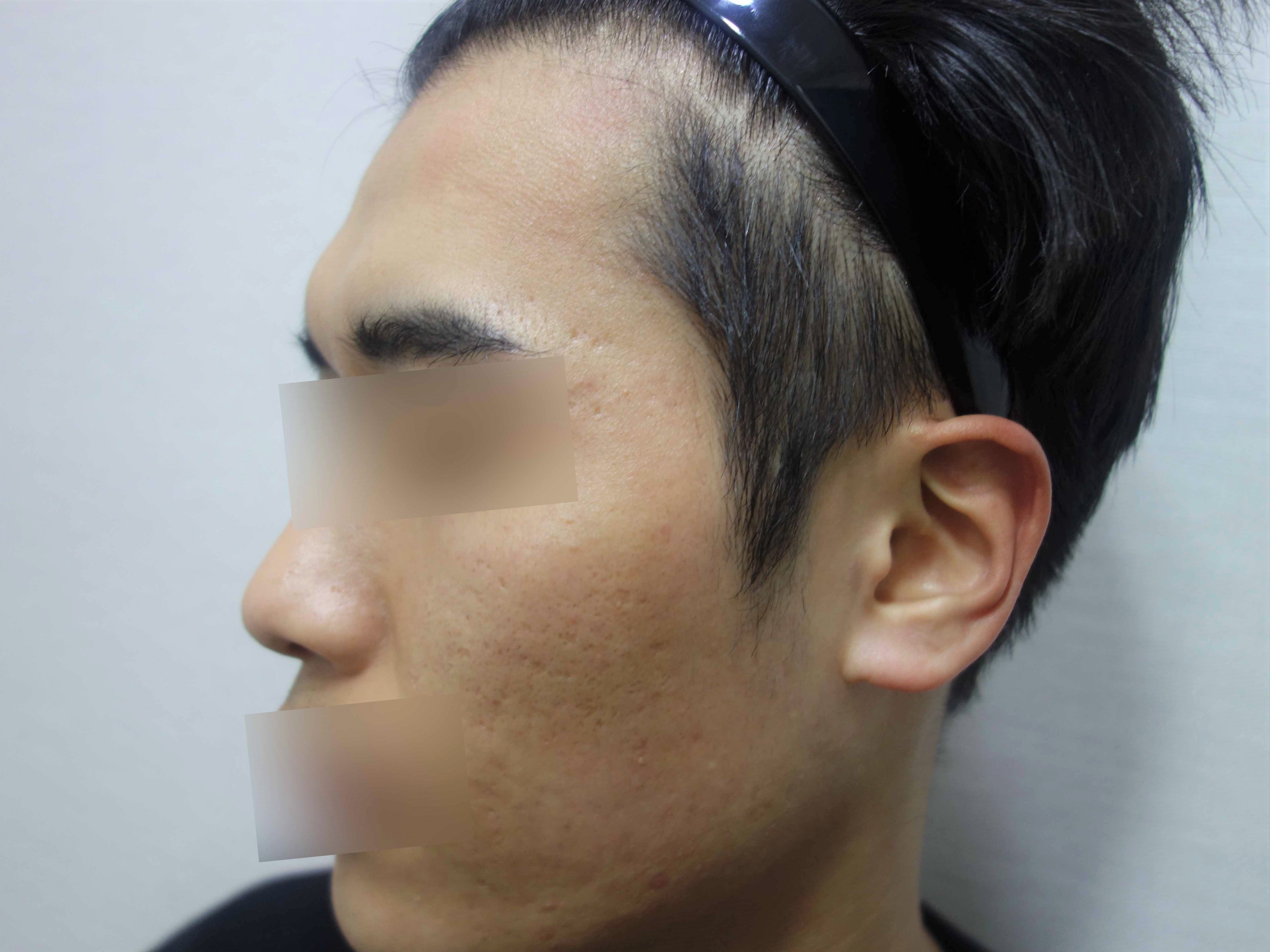 치료 후