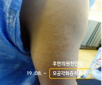 치료 전