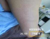치료 후