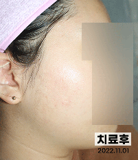 치료 후