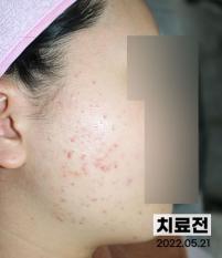 치료 전