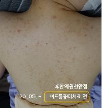 치료 전