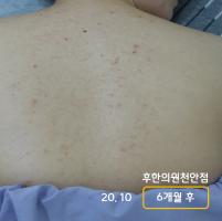 치료 후