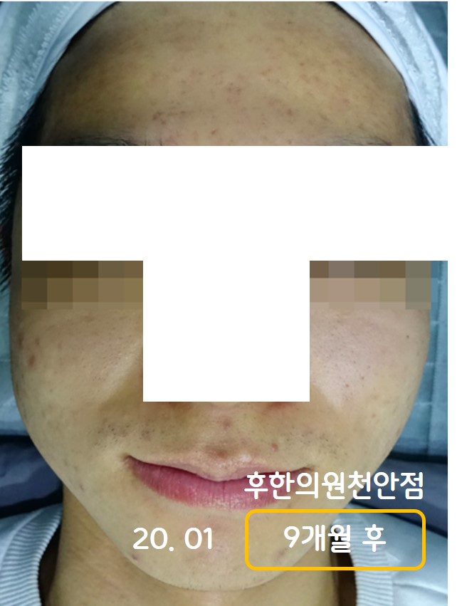 치료 후