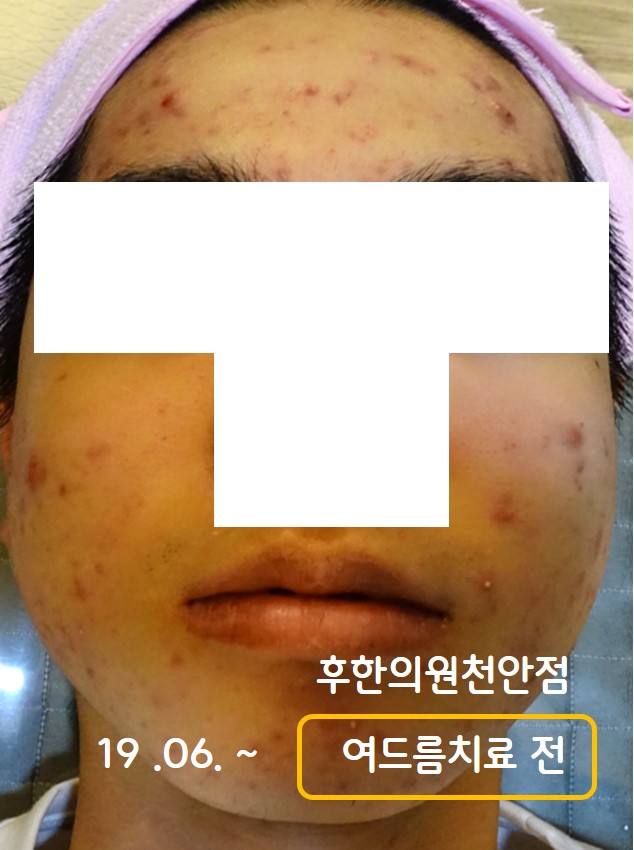 치료 전