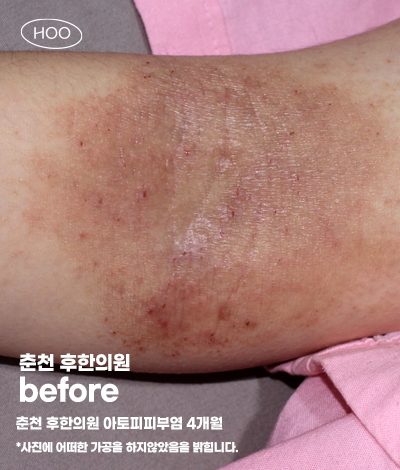 치료 전