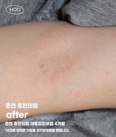 치료 후