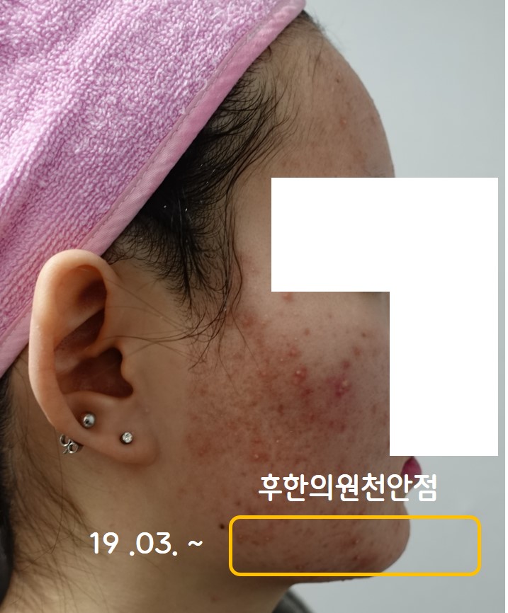 치료 전