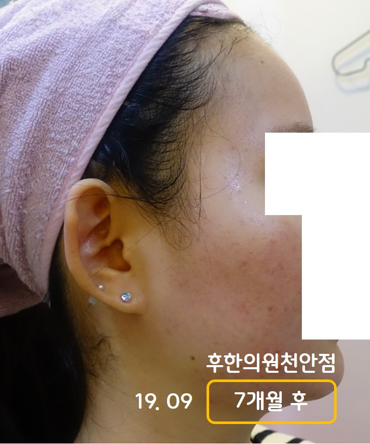 치료 후