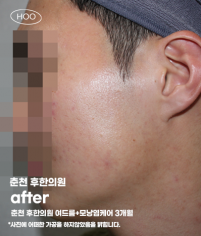 치료 후