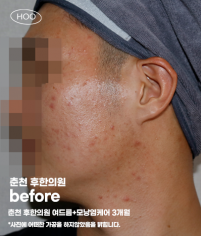 치료 전
