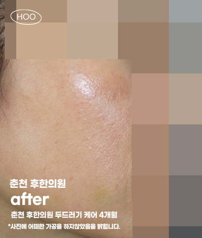 치료 후
