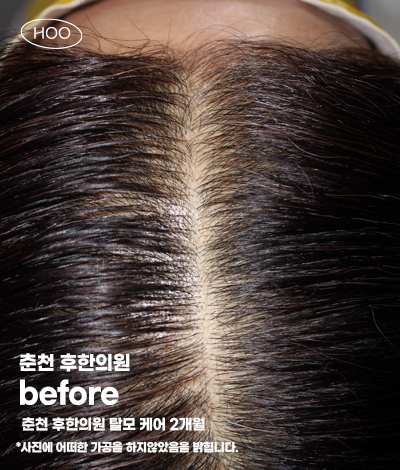 치료 전