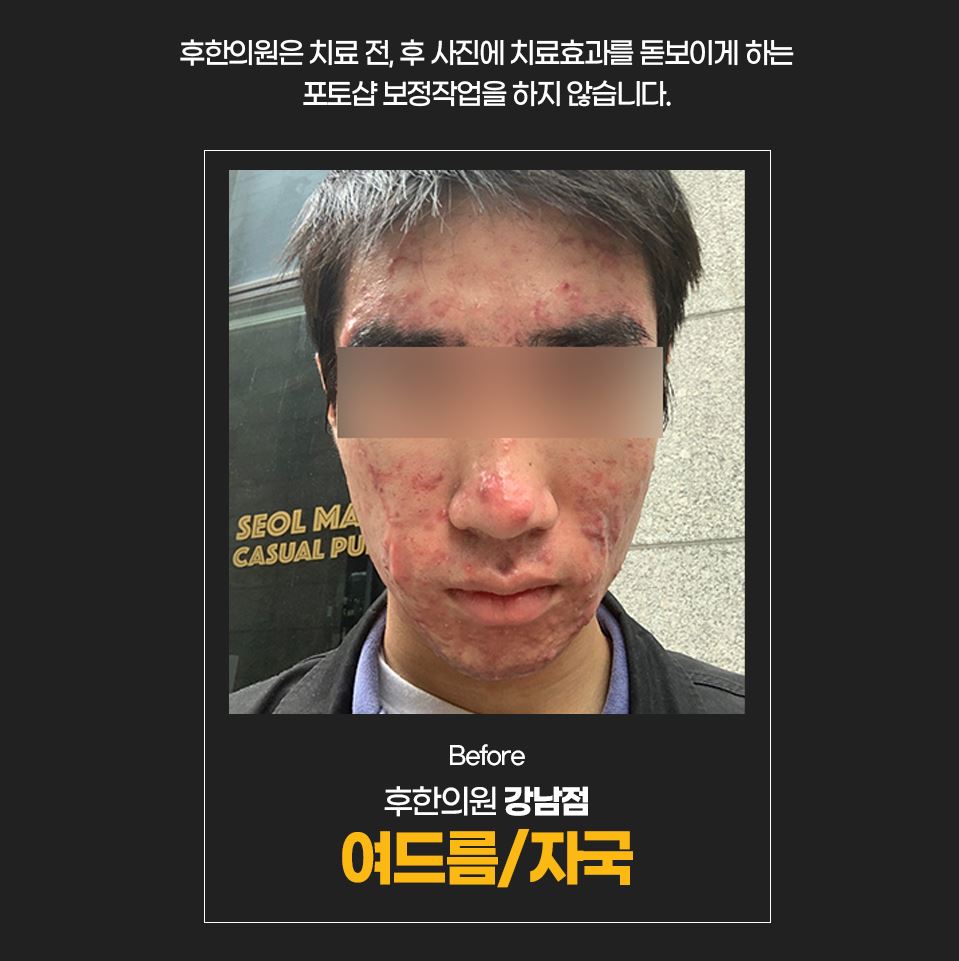 치료 전