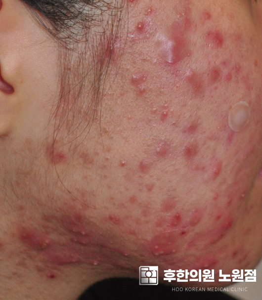 치료 전