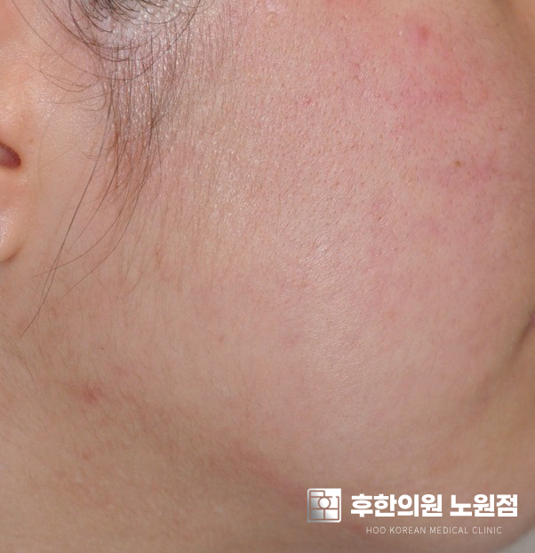 치료 후