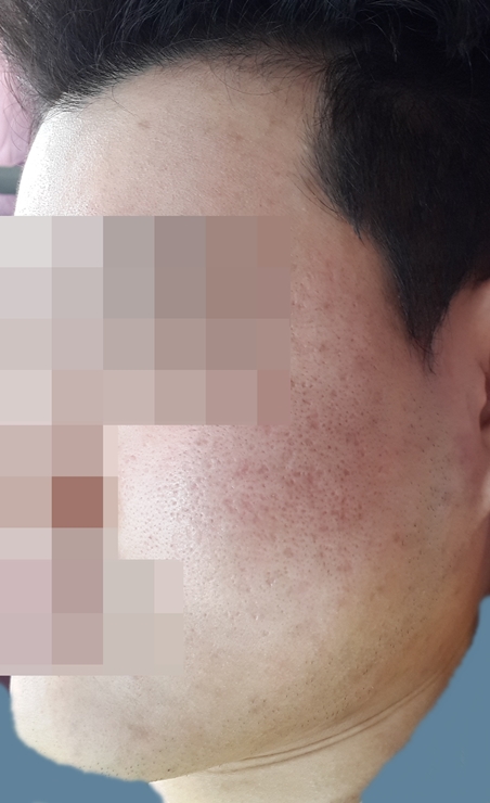 치료 후