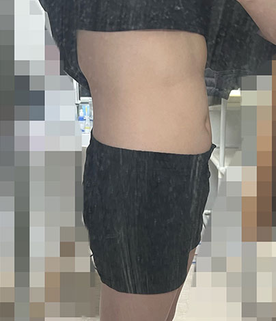 치료 후