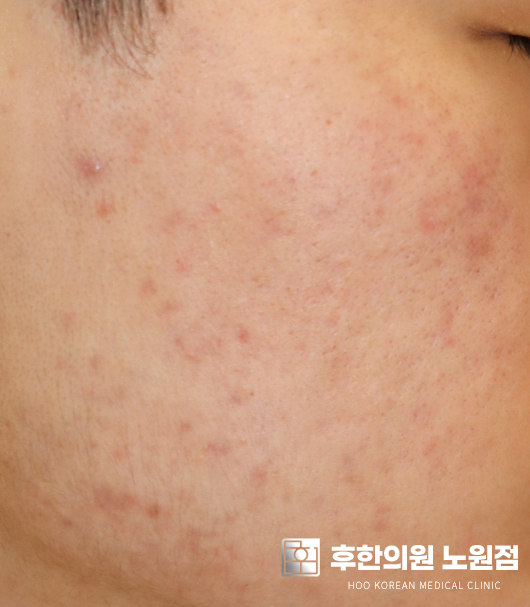 치료 후