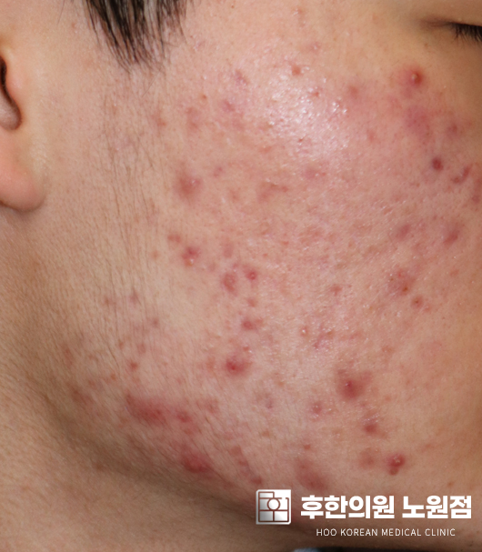 치료 전