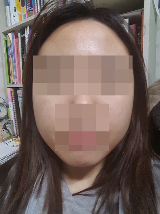 치료 후