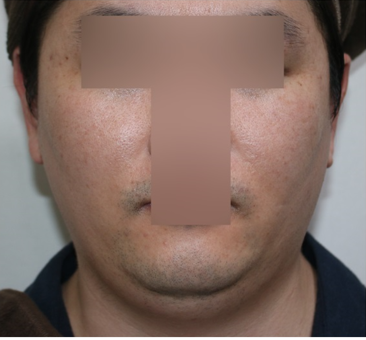 치료 전