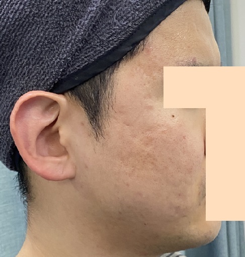 치료 후