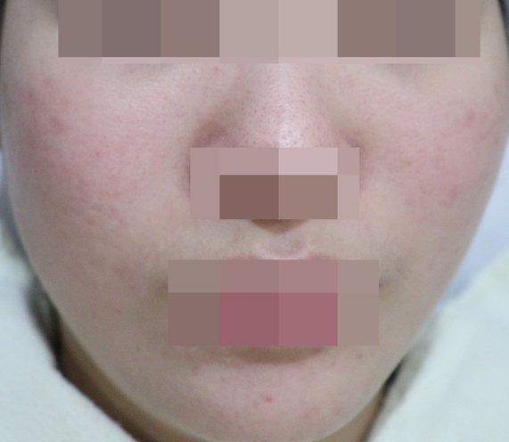 치료 후