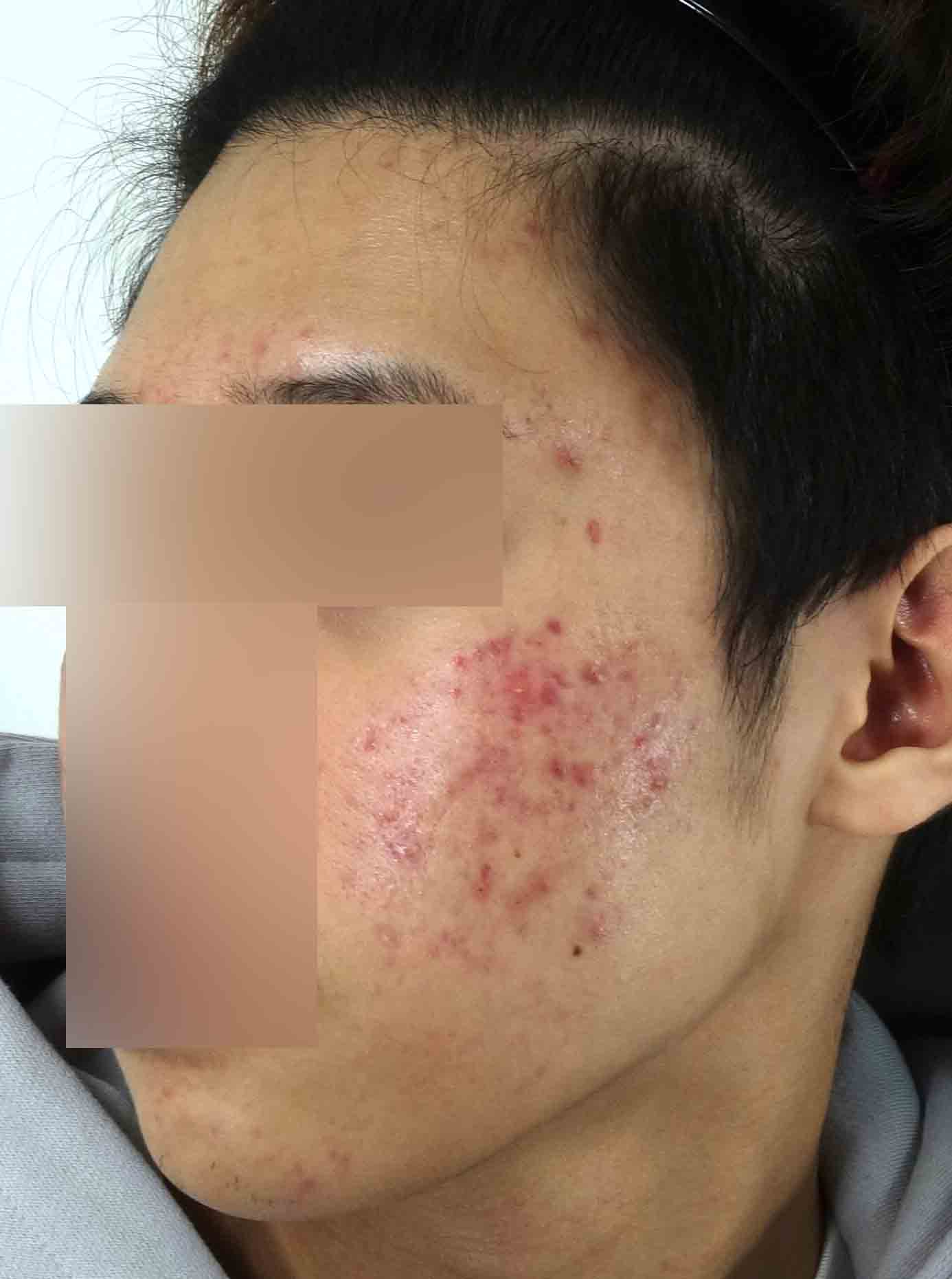 치료 전