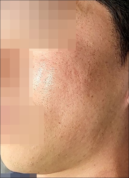 치료 후