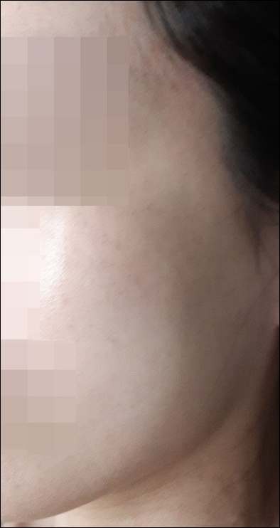 치료 후