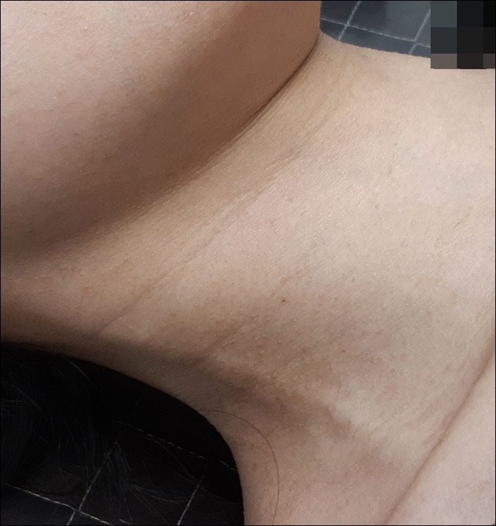 치료 후