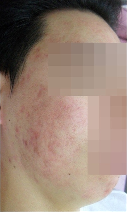 치료 후