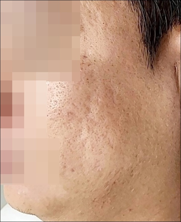 광주점 치료 후