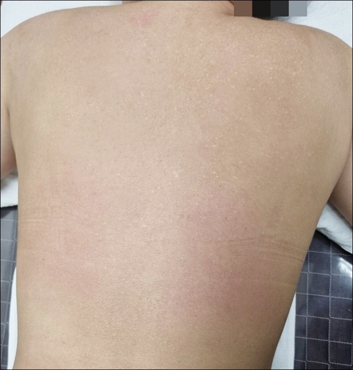 광주점 치료 후