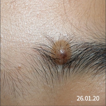 춘천점 치료 전