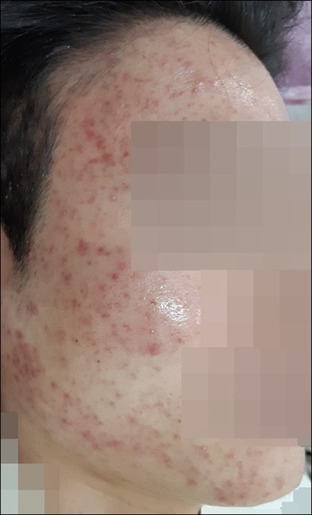 광주점 치료 전