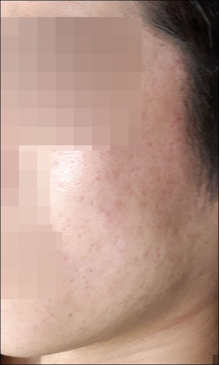 치료 후
