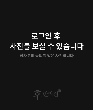 치료 후