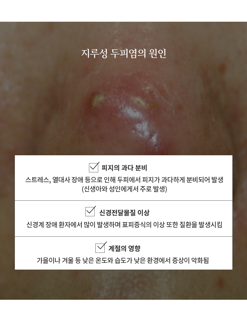 지루성두피염