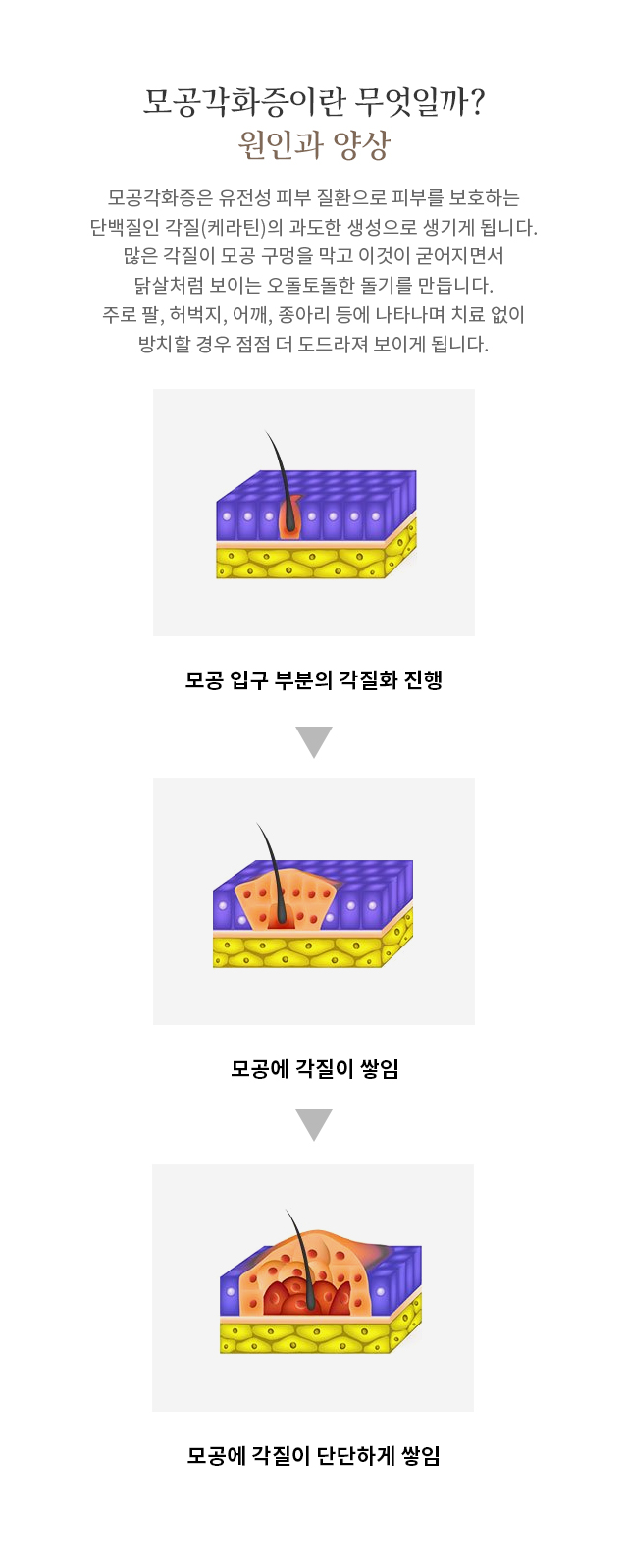 모공각화증